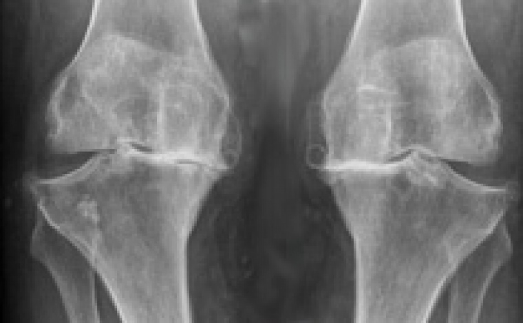 gallery/arthrose_genou