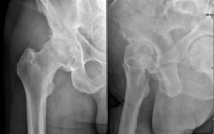 gallery/arthrose_hanche